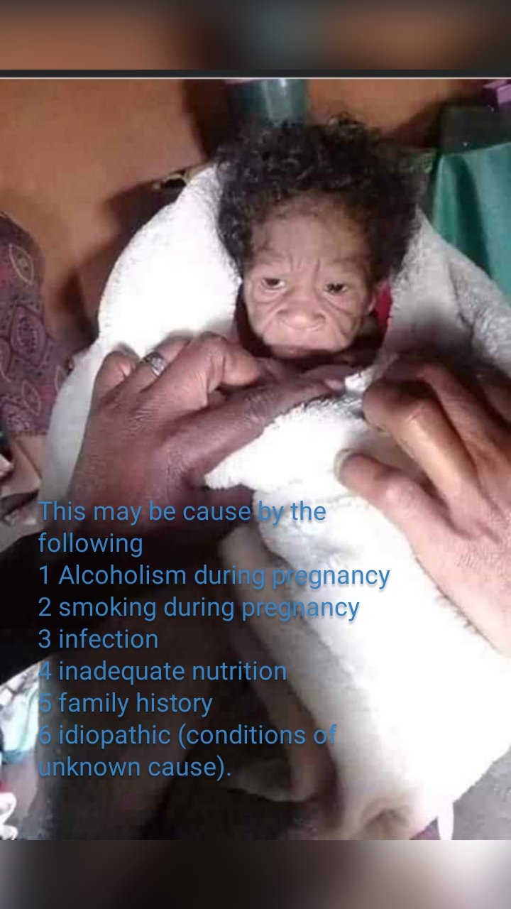 
 This may be cause by the following
1 Alcoholism during pregnancy
2 smoking during pregnancy
3 infection
4 inadequate nutrition
5 family history
6 idiopathic (conditions of unknown cause).

